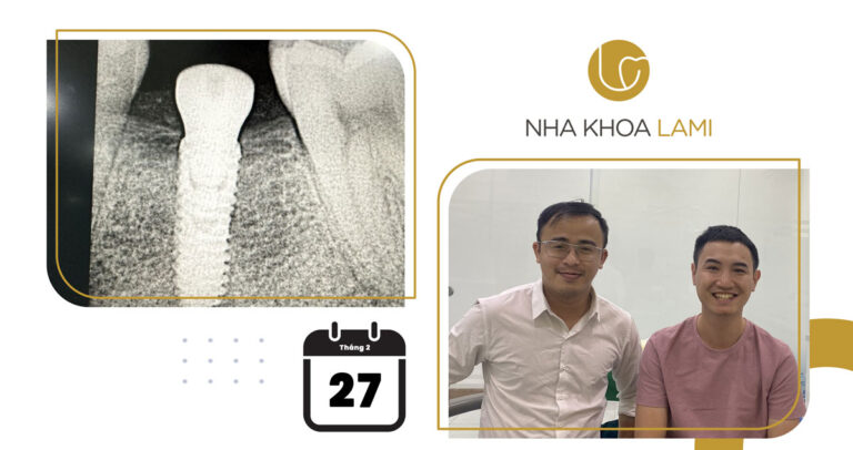 Implant và phục hình sứ ngày 27/02