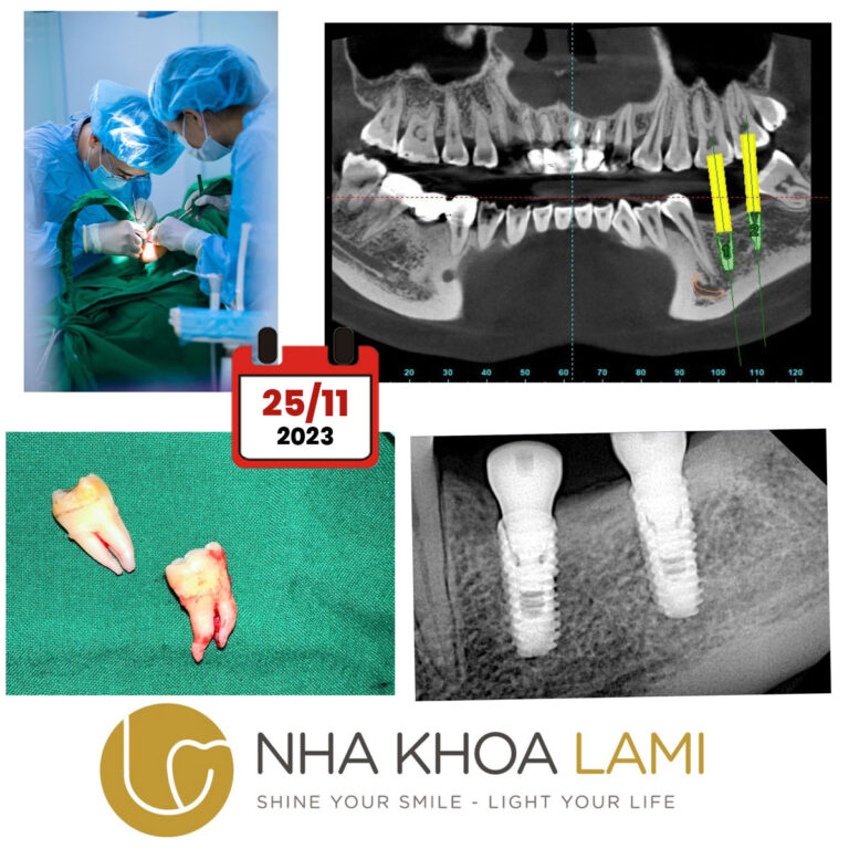 nho rang khon va trong rang implant 2511