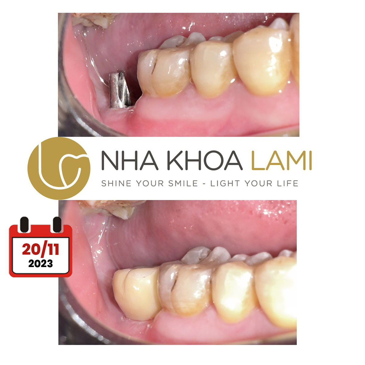 Trồng Răng Implant - Nha Khoa Uy Tín Quận 2 Thủ Đức