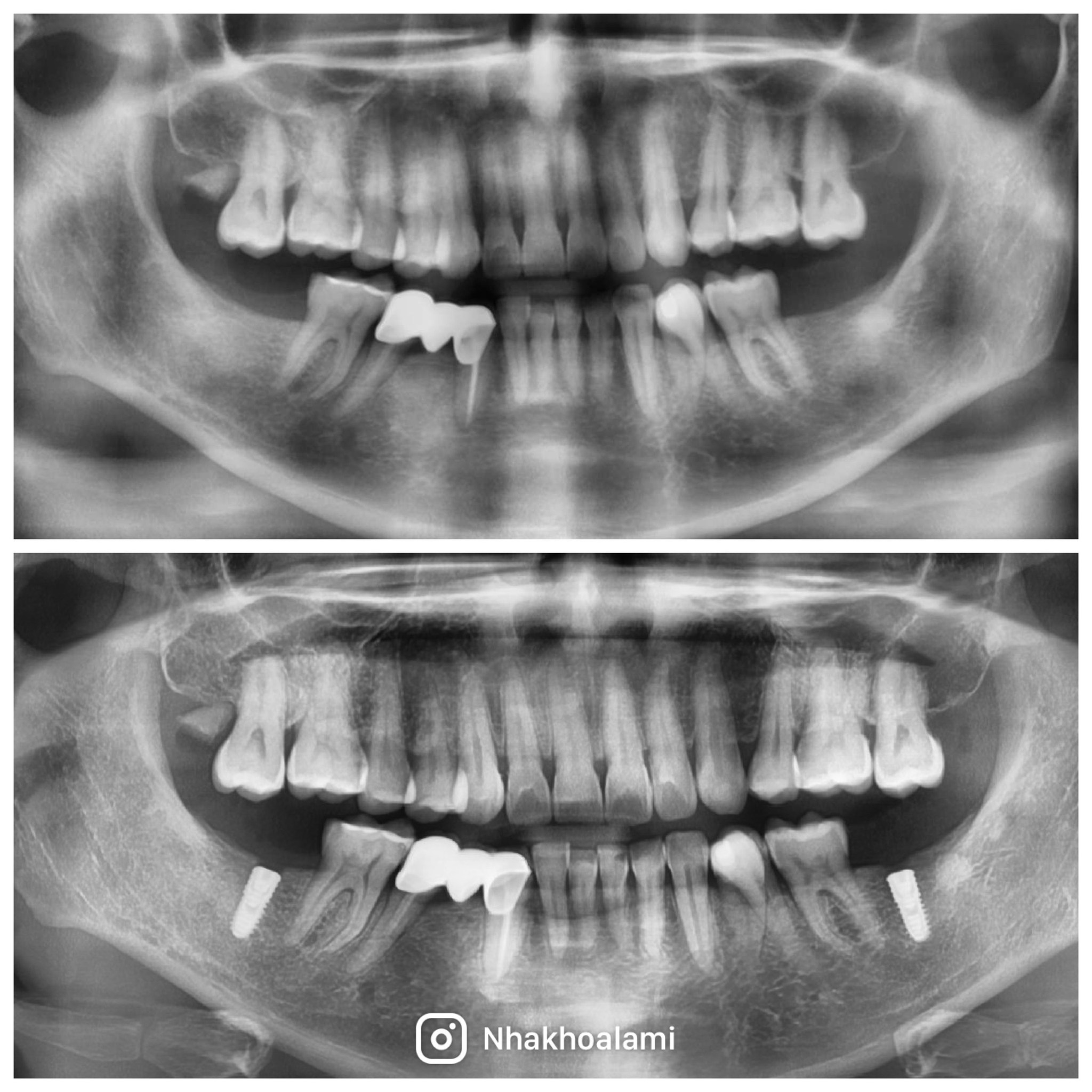 Trồng răng Implant chính hãng giá rẻ Thủ Đức case2707 3